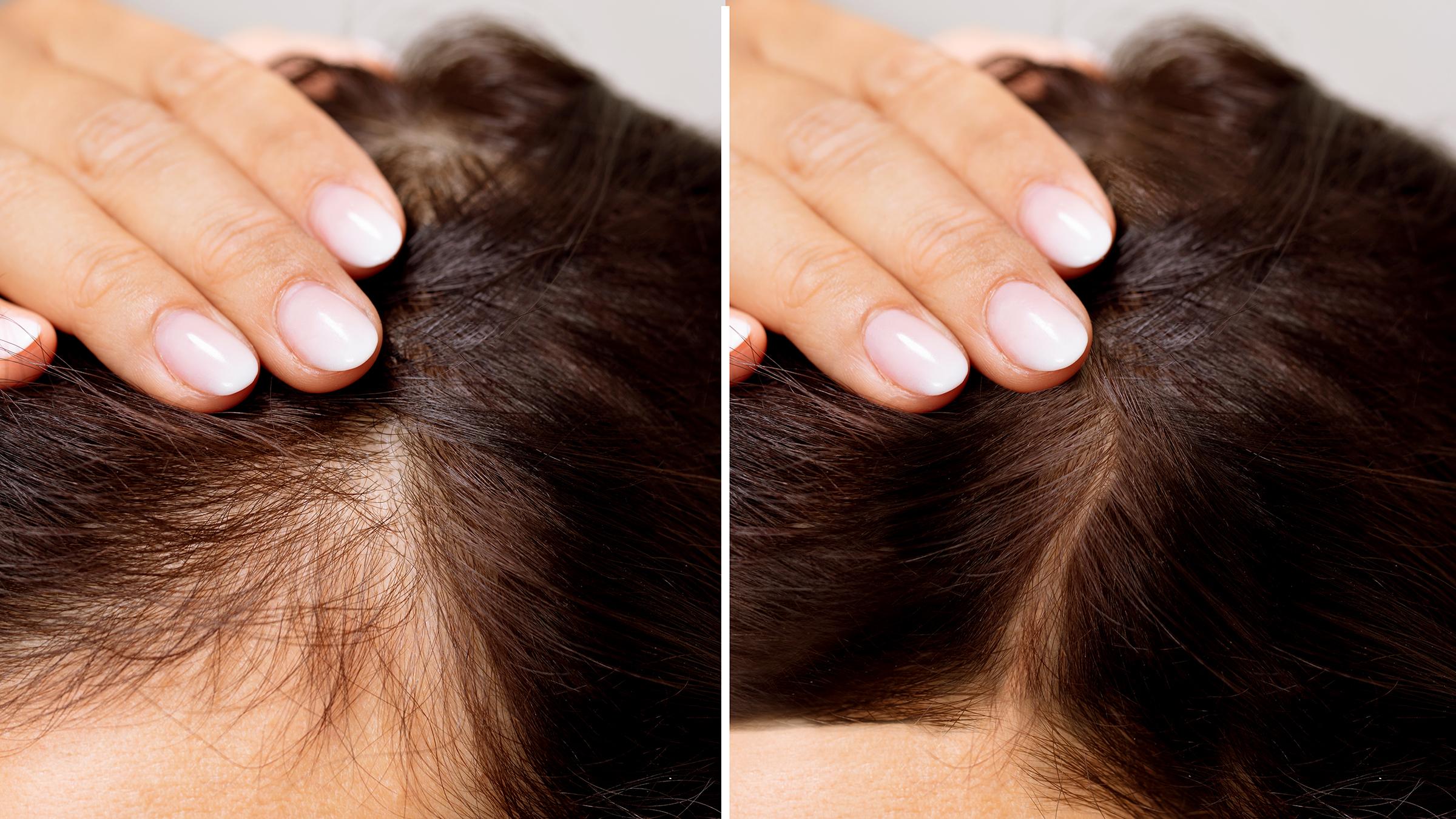 hair loss treatment