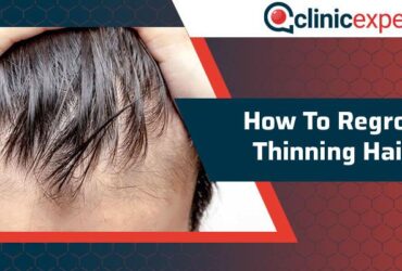 How to regrow thinning hair in men over 40