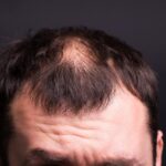 How to fix thinning hair for men over 40