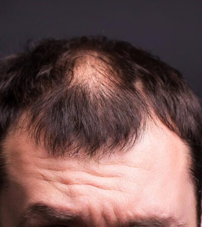 How to fix thinning hair for men over 40