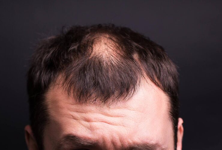 How to fix thinning hair for men over 40