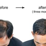 Hair loss treatments for men over 40