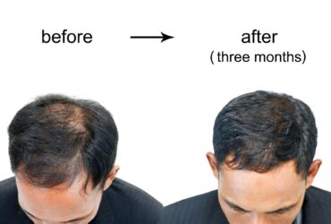 Hair loss treatments for men over 40