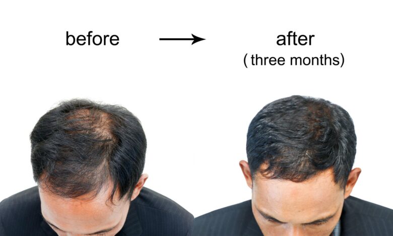 Hair loss treatments for men over 40