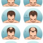 Best hair growth treatments for receding hairline in men over 40