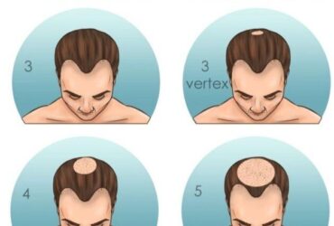 Best hair growth treatments for receding hairline in men over 40