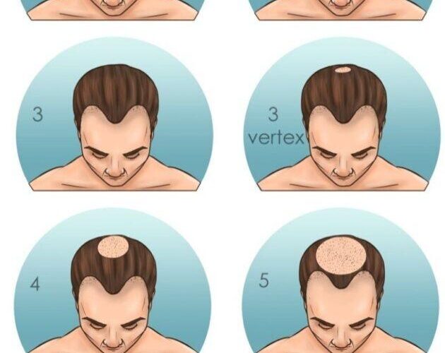 Best hair growth treatments for receding hairline in men over 40