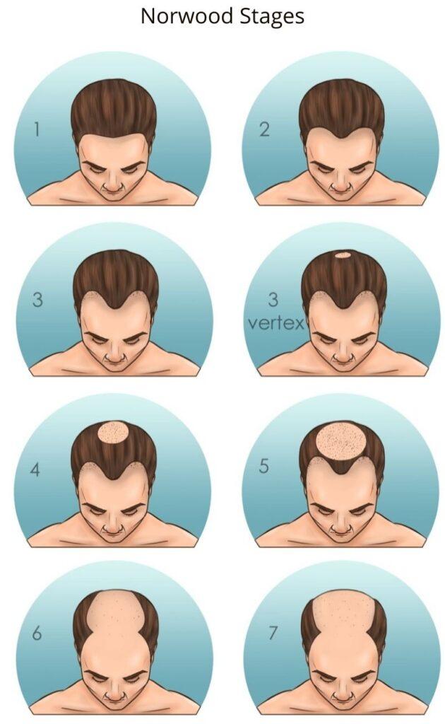 Best hair growth treatments for receding hairline in men over 40