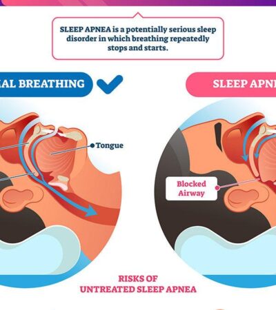 Testosterone therapy and sleep apnea