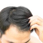 How to regrow hair for men over 40