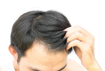 How to regrow hair for men over 40