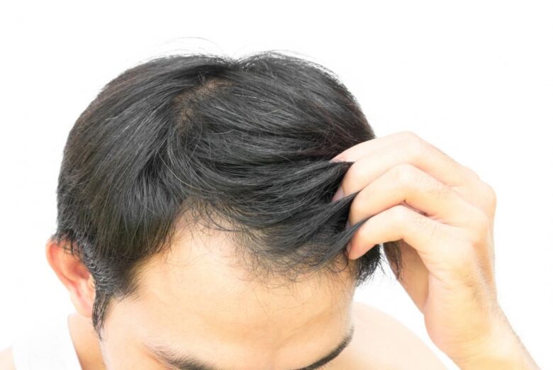 How to regrow hair for men over 40