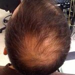 Testosterone therapy and hair loss