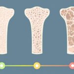 Testosterone therapy for bone density