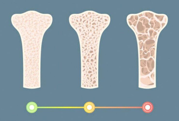 Testosterone therapy for bone density