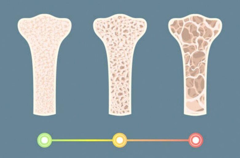 Testosterone therapy for bone density