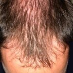 How to treat hair loss in men over 40