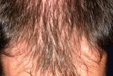 How to treat hair loss in men over 40