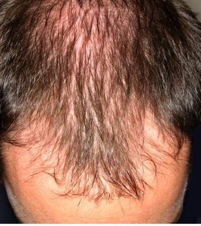 How to treat hair loss in men over 40