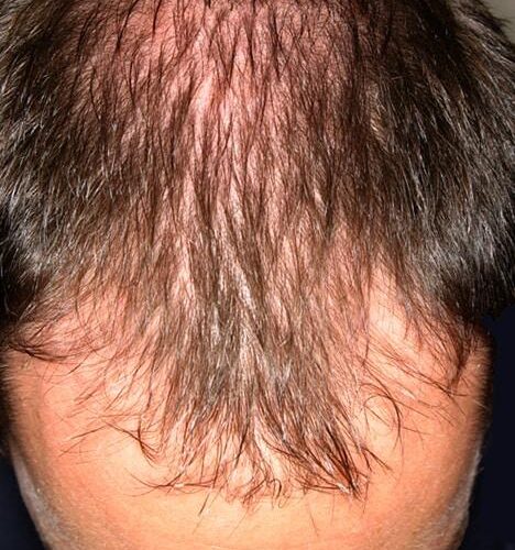 How to treat hair loss in men over 40