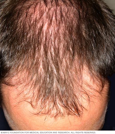 How to treat hair loss in men over 40