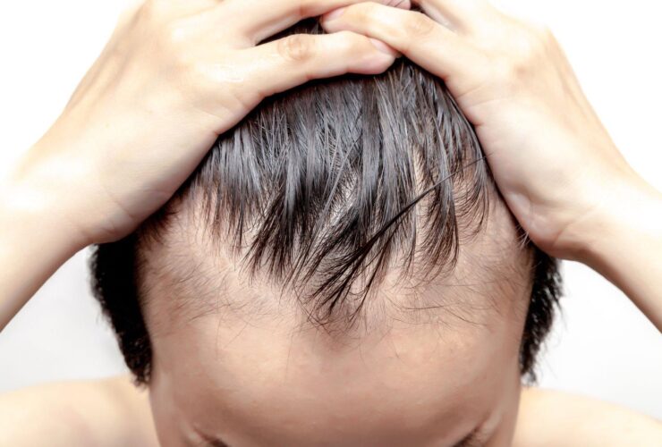 How to reverse hair loss in men over 40