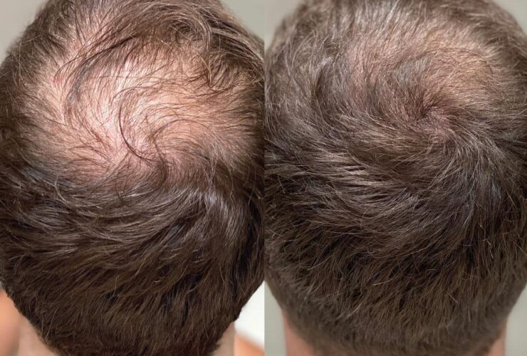 PRP hair treatment for men over 40