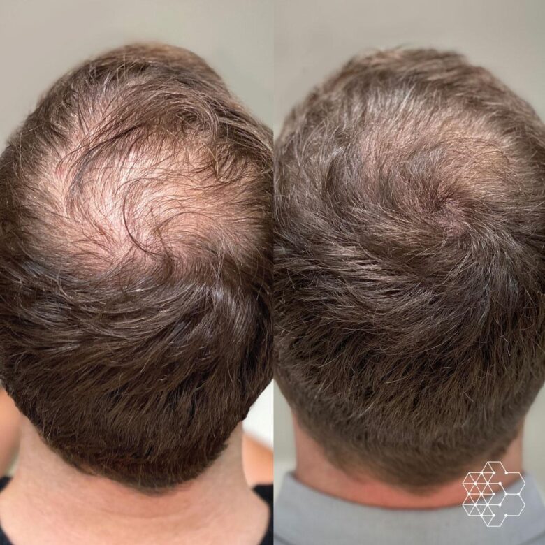 PRP hair treatment for men over 40