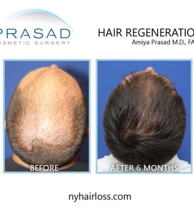 Hair transplant alternatives for men over 40