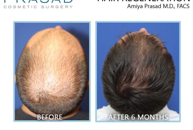 Hair transplant alternatives for men over 40