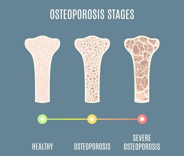 Testosterone therapy for osteoporosis