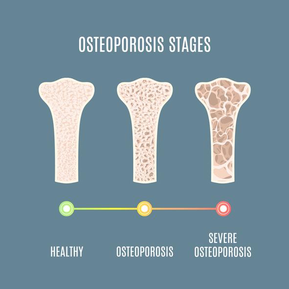 Testosterone therapy for osteoporosis