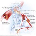 Testosterone therapy for high blood pressure