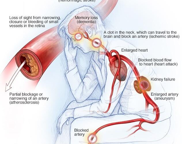 Testosterone therapy for high blood pressure