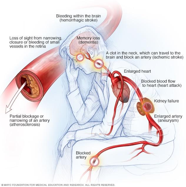 Testosterone therapy for high blood pressure