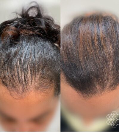 How to prevent hair thinning for men over 40