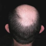 How to slow down hair loss in men over 40