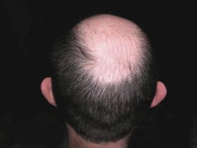 How to slow down hair loss in men over 40