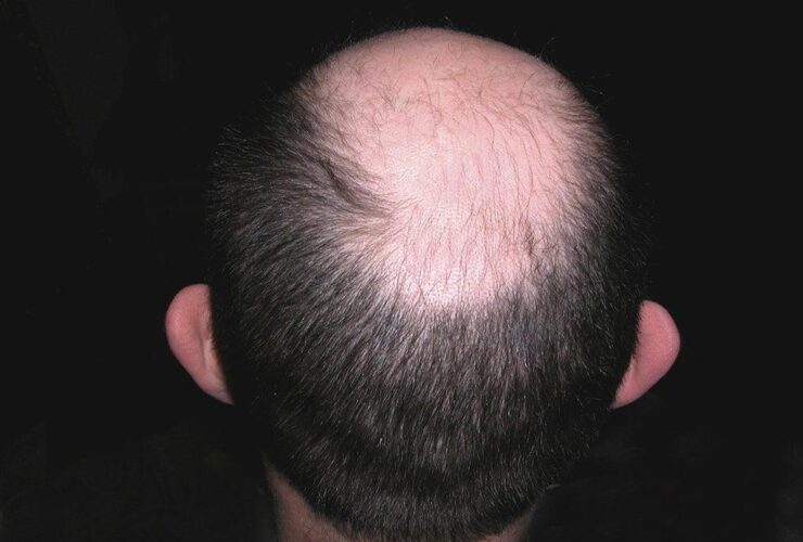 How to slow down hair loss in men over 40