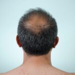 Regrowth solutions for men’s hair after 40