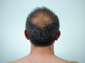 Regrowth solutions for men’s hair after 40