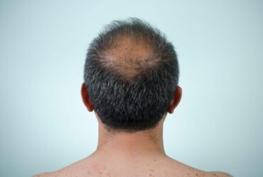 Regrowth solutions for men’s hair after 40