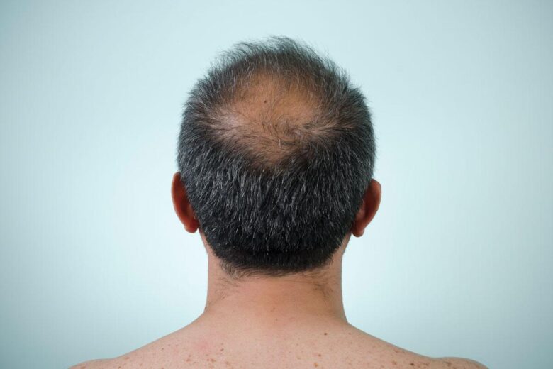 Men’s hair regrowth treatments after 40