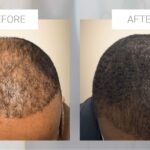 Hair restoration for men over 40