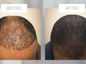 Hair restoration for men over 40