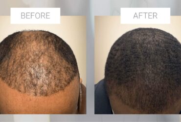 Hair restoration for men over 40