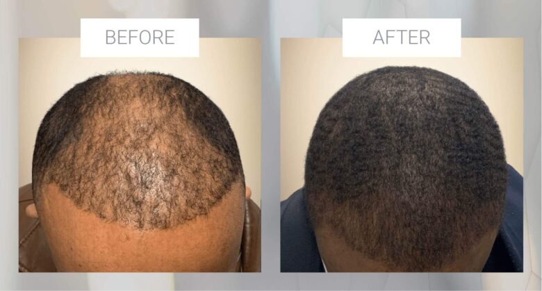 Hair restoration for men over 40