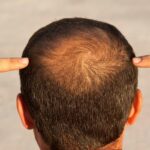 Non-surgical hair restoration for men over 40