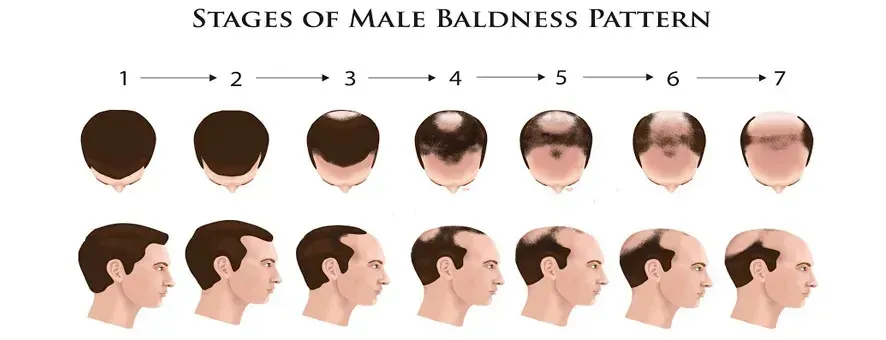 male pattern baldness