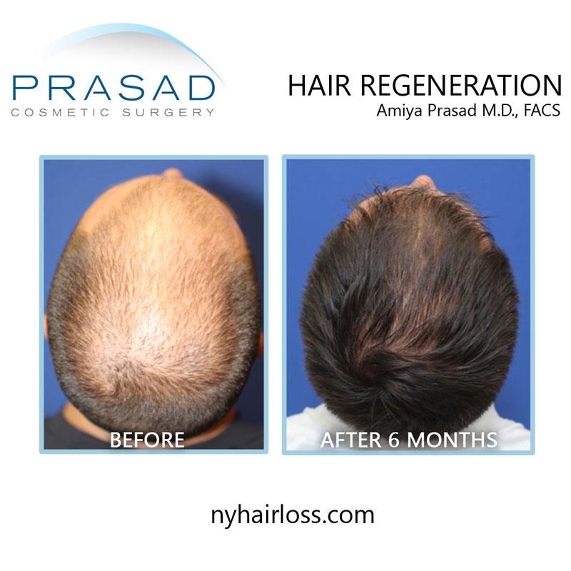 non-surgical hair restoration